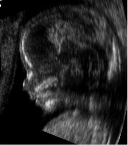 Embarazo: ¿Cómo se interpreta una ecografía?